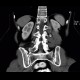 Angiomyolipoma of kidney, atypical: CT - Computed tomography